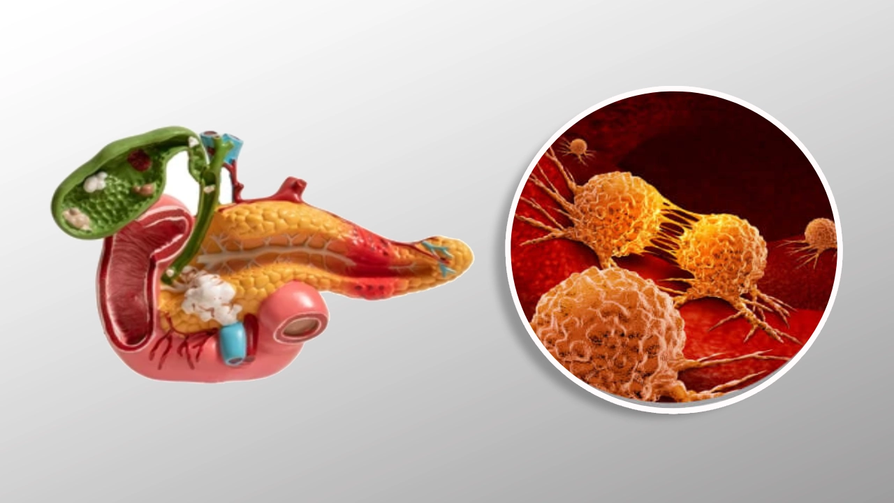  pancreatic-cancer-treatment-coimbatore-chennai